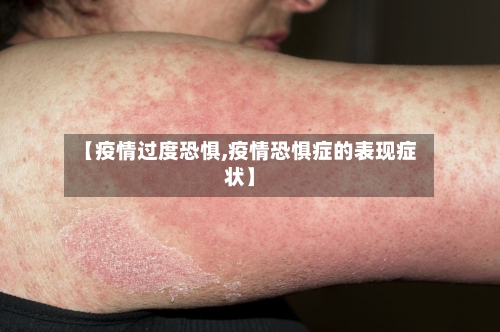 【疫情过度恐惧,疫情恐惧症的表现症状】-第2张图片